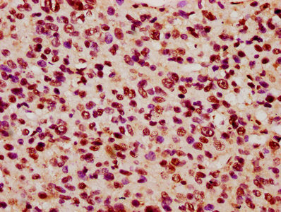 IHC image of KIF3C Antibody diluted at 1:600 and staining in paraffin-embedded human glioma performed on a Leica BondTM system. After dewaxing and hydration, antigen retrieval was mediated by high pressure in a citrate buffer (pH 6.0). Section was blocked with 10% normal goat serum 30min at RT. Then primary antibody (1% BSA) was incubated at 4°C overnight. The primary is detected by a biotinylated secondary antibody and visualized using an HRP conjugated SP system.