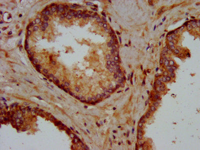 IHC image of KIFAP3 Antibody diluted at 1:400 and staining in paraffin-embedded human prostate cancer performed on a Leica BondTM system. After dewaxing and hydration, antigen retrieval was mediated by high pressure in a citrate buffer (pH 6.0). Section was blocked with 10% normal goat serum 30min at RT. Then primary antibody (1% BSA) was incubated at 4°C overnight. The primary is detected by a biotinylated secondary antibody and visualized using an HRP conjugated SP system.