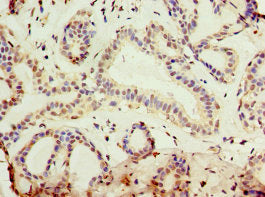 Immunohistochemistry of paraffin-embedded human breast cancer using the antibody at dilution of 1:100