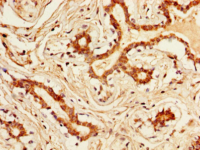 IHC image of the antibody diluted at 1:300 and staining in paraffin-embedded human breast cancer performed on a Leica BondTM system. After dewaxing and hydration, antigen retrieval was mediated by high pressure in a citrate buffer (pH 6.0). Section was blocked with 10% normal goat serum 30min at RT. Then primary antibody (1% BSA) was incubated at 4°C overnight. The primary is detected by a biotinylated secondary antibody and visualized using an HRP conjugated SP system.