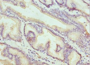 Immunohistochemistry of paraffin-embedded human prostate cancer using KLK10 Antibody at dilution of 1:100