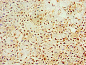 Immunohistochemistry of paraffin-embedded human breast cancer using the antibody at dilution of 1:100