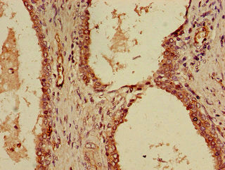 Immunohistochemistry of paraffin-embedded human prostate cancer using KPNA4 Antibody at dilution of 1:100