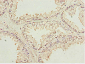 Immunohistochemistry of paraffin-embedded human prostate cancer using KPNA6 Antibody at dilution of 1:100