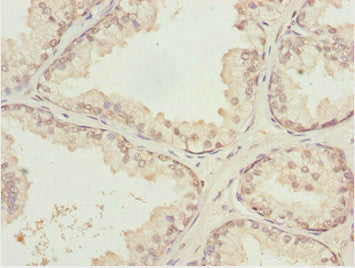 Immunohistochemistry of paraffin-embedded human prostate cancer using KPNA6 Antibody at dilution of 1:100Rabbit anti-Human KPNA6 Polyclonal Antibody