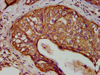 IHC image of the antibody diluted at 1:400 and staining in paraffin-embedded human cervical cancer performed on a Leica BondTM system. After dewaxing and hydration, antigen retrieval was mediated by high pressure in a citrate buffer (pH 6.0). Section was blocked with 10% normal goat serum 30min at RT. Then primary antibody (1% BSA) was incubated at 4°C overnight. The primary is detected by a biotinylated secondary antibody and visualized using an HRP conjugated SP system.