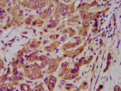 IHC image of KRT1 Antibody diluted at 1:400 and staining in paraffin-embedded human liver cancer performed on a Leica BondTM system. After dewaxing and hydration, antigen retrieval was mediated by high pressure in a citrate buffer (pH 6.0). Section was blocked with 10% normal goat serum 30min at RT. Then primary antibody (1% BSA) was incubated at 4°C overnight. The primary is detected by a biotinylated secondary antibody and visualized using an HRP conjugated SP system.