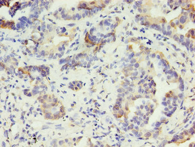 Immunohistochemistry of paraffin-embedded human lung cancer using KRT10 Antibody at dilution of 1:100