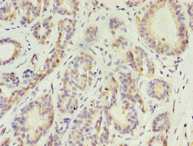 Immunohistochemistry of paraffin-embedded human breast cancer using KRT10 Antibody at dilution of 1:100