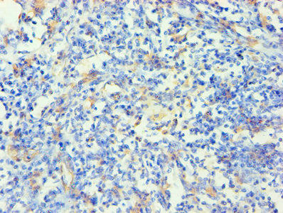 Immunohistochemistry of paraffin-embedded human cervical cancer using KRT14 Antibody at dilution of 1:100