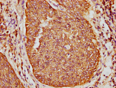 IHC image of KRT16 Antibody diluted at 1:400 and staining in paraffin-embedded human cervical cancer performed on a Leica BondTM system. After dewaxing and hydration, antigen retrieval was mediated by high pressure in a citrate buffer (pH 6.0). Section was blocked with 10% normal goat serum 30min at RT. Then primary antibody (1% BSA) was incubated at 4°C overnight. The primary is detected by a biotinylated secondary antibody and visualized using an HRP conjugated SP system.