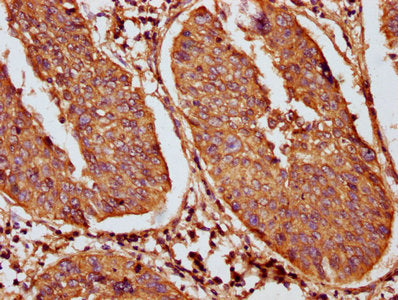 IHC image of Krt18 Antibody diluted at 1:100 and staining in paraffin-embedded human cervical cancer performed on a Leica BondTM system. After dewaxing and hydration, antigen retrieval was mediated by high pressure in a citrate buffer (pH 6.0). Section was blocked with 10% normal goat serum 30min at RT. Then primary antibody (1% BSA) was incubated at 4°C overnight. The primary is detected by a biotinylated secondary antibody and visualized using an HRP conjugated SP system.Rabbit anti-Mus musculus (Mouse) Krt18 Polyclonal Antibody