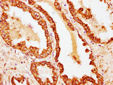 IHC image of Krt18 Antibody diluted at 1:100 and staining in paraffin-embedded human prostate cancer performed on a Leica BondTM system. After dewaxing and hydration, antigen retrieval was mediated by high pressure in a citrate buffer (pH 6.0). Section was blocked with 10% normal goat serum 30min at RT. Then primary antibody (1% BSA) was incubated at 4°C overnight. The primary is detected by a biotinylated secondary antibody and visualized using an HRP conjugated SP system.Rabbit anti-Mus musculus (Mouse) Krt18 Polyclonal Antibody