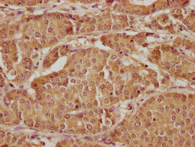 IHC image of the antibody diluted at 1:300 and staining in paraffin-embedded human gastric cancer performed on a Leica BondTM system. After dewaxing and hydration, antigen retrieval was mediated by high pressure in a citrate buffer (pH 6.0). Section was blocked with 10% normal goat serum 30min at RT. Then primary antibody (1% BSA) was incubated at 4°C overnight. The primary is detected by a biotinylated secondary antibody and visualized using an HRP conjugated SP system.