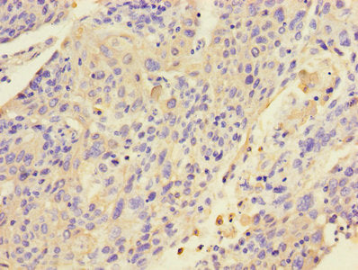 Immunohistochemistry of paraffin-embedded human cervical cancer using the antibody at dilution of 1:100