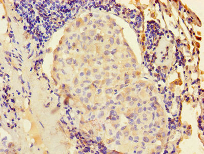 Immunohistochemistry of paraffin-embedded human lung cancer using the antibody at dilution of 1:100