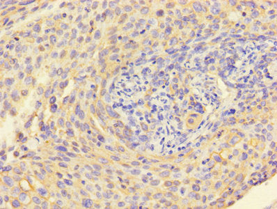 Immunohistochemistry of paraffin-embedded human cervical cancer using KRT6A Antibody at dilution of 1:100