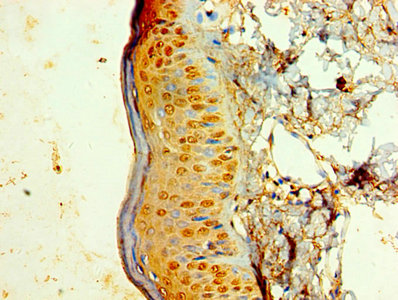 Immunohistochemistry of paraffin-embedded human skin tissue using KRT6A Antibody at dilution of 1:100