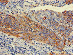 Immunohistochemistry of paraffin-embedded human cervical cancer using KRT7 Antibody at dilution of 1:100
