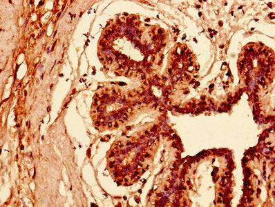 Immunohistochemistry of paraffin-embedded human breast cancer using KRT81 Antibody at dilution of 1:100