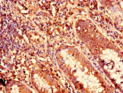 Immunohistochemistry of paraffin-embedded human colon cancer using KRT81 Antibody at dilution of 1:100