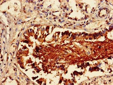 Immunohistochemistry of paraffin-embedded human lung cancer using the antibody at dilution of 1:100