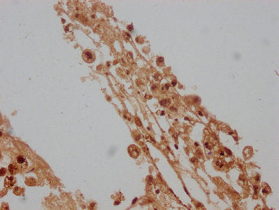 IHC image of the antibody diluted at 1:100 and staining in paraffin-embedded human melanoma cancer performed on a Leica BondTM system. After dewaxing and hydration, antigen retrieval was mediated by high pressure in a citrate buffer (pH 6.0). Section was blocked with 10% normal goat serum 30min at RT. Then primary antibody (1% BSA) was incubated at 4°C overnight. The primary is detected by a biotinylated secondary antibody and visualized using an HRP conjugated SP system.