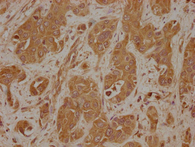 IHC image of LAMB4 Antibody diluted at 1:100 and staining in paraffin-embedded human liver cancer performed on a Leica BondTM system. After dewaxing and hydration, antigen retrieval was mediated by high pressure in a citrate buffer (pH 6.0). Section was blocked with 10% normal goat serum 30min at RT. Then primary antibody (1% BSA) was incubated at 4°C overnight. The primary is detected by a biotinylated secondary antibody and visualized using an HRP conjugated SP system.