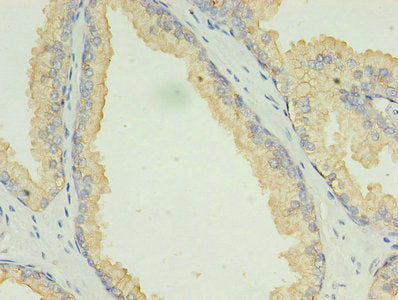 Immunohistochemistry of paraffin-embedded human prostate cancer using LAMP2 Antibody at dilution of 1:100