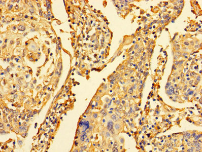 Immunohistochemistry of paraffin-embedded human cervical cancer using DYNLL1 Antibody at dilution of 1:100Rabbit anti-Human DYNLL1 Polyclonal Antibody