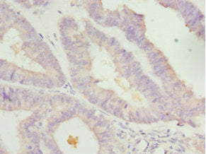 Immunohistochemistry of paraffin-embedded human endometrial cancer using LEFTY2 Antibody at dilution of 1: 100