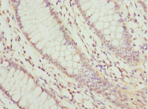 Immunohistochemistry of paraffin-embedded human colon cancer using LEFTY2 Antibody at dilution of 1: 100