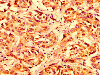 IHC image of LETM1 Antibody diluted at 1:300 and staining in paraffin-embedded human liver cancer performed on a Leica BondTM system. After dewaxing and hydration, antigen retrieval was mediated by high pressure in a citrate buffer (pH 6.0). Section was blocked with 10% normal goat serum 30min at RT. Then primary antibody (1% BSA) was incubated at 4°C overnight. The primary is detected by a biotinylated secondary antibody and visualized using an HRP conjugated SP system.