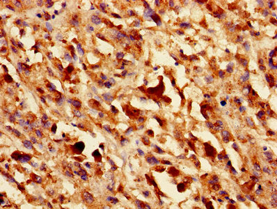 Immunohistochemistry of paraffin-embedded human melanoma using LGALS1 Antibody at dilution of 1:100