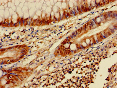 Immunohistochemistry of paraffin-embedded human colon cancer using LGALS3 Antibody at dilution of 1:100