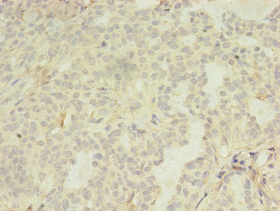 Immunohistochemistry of paraffin-embedded human breast cancer using LILRA4 Antibody at dilution of 1:100