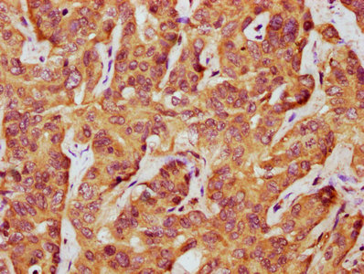 IHC image of the antibody diluted at 1:500 and staining in paraffin-embedded human liver cancer performed on a Leica BondTM system. After dewaxing and hydration, antigen retrieval was mediated by high pressure in a citrate buffer (pH 6.0). Section was blocked with 10% normal goat serum 30min at RT. Then primary antibody (1% BSA) was incubated at 4°C overnight. The primary is detected by a biotinylated secondary antibody and visualized using an HRP conjugated SP system.