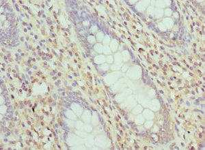Immunohistochemistry of paraffin-embedded human colon cancer using the antibody at dilution of 1:100