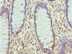 Immunohistochemistry of paraffin-embedded human colon cancer using LIMS1 Antibody at dilution of 1:100