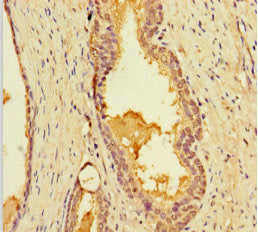 Immunohistochemistry of paraffin-embedded human prostate cancer using the antibody at dilution of 1:100