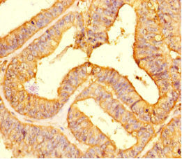 Immunohistochemistry of paraffin-embedded human endometrial cancer using LIMS3 Antibody at dilution of 1:100