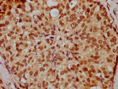 IHC image of LMNA Antibody diluted at 1:200 and staining in paraffin-embedded human breast cancer performed on a Leica BondTM system. After dewaxing and hydration, antigen retrieval was mediated by high pressure in a citrate buffer (pH 6.0). Section was blocked with 10% normal goat serum 30min at RT. Then primary antibody (1% BSA) was incubated at 4°C overnight. The primary is detected by a biotinylated secondary antibody and visualized using an HRP conjugated SP system.
