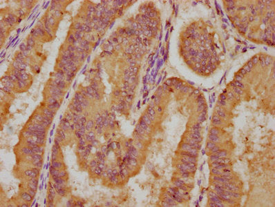 IHC image of the antibody diluted at 1:200 and staining in paraffin-embedded human endometrial cancer performed on a Leica BondTM system. After dewaxing and hydration, antigen retrieval was mediated by high pressure in a citrate buffer (pH 6.0). Section was blocked with 10% normal goat serum 30min at RT. Then primary antibody (1% BSA) was incubated at 4°C overnight. The primary is detected by a biotinylated secondary antibody and visualized using an HRP conjugated SP system.