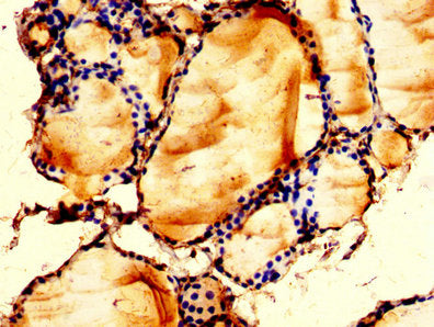 IHC image of LPCAT2 Antibody diluted at 1:200 and staining in paraffin-embedded human thyroid tissue performed on a Leica BondTM system. After dewaxing and hydration, antigen retrieval was mediated by high pressure in a citrate buffer (pH 6.0). Section was blocked with 10% normal goat serum 30min at RT. Then primary antibody (1% BSA) was incubated at 4°C overnight. The primary is detected by a biotinylated secondary antibody and visualized using an HRP conjugated SP system.