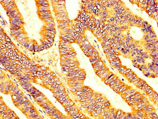 IHC image of LPCAT2 Antibody diluted at 1:200 and staining in paraffin-embedded human colon cancer performed on a Leica BondTM system. After dewaxing and hydration, antigen retrieval was mediated by high pressure in a citrate buffer (pH 6.0). Section was blocked with 10% normal goat serum 30min at RT. Then primary antibody (1% BSA) was incubated at 4°C overnight. The primary is detected by a biotinylated secondary antibody and visualized using an HRP conjugated SP system.