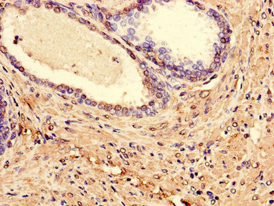 Immunohistochemistry of paraffin-embedded human prostate cancer using the antibody at dilution of 1:100