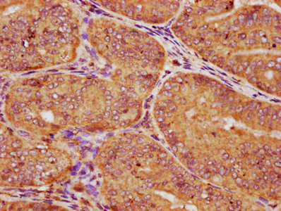IHC image of CSNK1E Antibody diluted at 1:150 and staining in paraffin-embedded human endometrial cancer performed on a Leica BondTM system. After dewaxing and hydration, antigen retrieval was mediated by high pressure in a citrate buffer (pH 6.0). Section was blocked with 10% normal goat serum 30min at RT. Then primary antibody (1% BSA) was incubated at 4°C overnight. The primary is detected by a biotinylated secondary antibody and visualized using an HRP conjugated SP system.Rabbit anti-Human CSNK1E Polyclonal Antibody