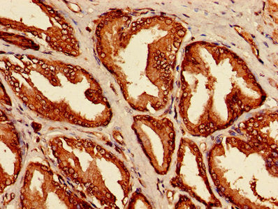 Immunohistochemistry of paraffin-embedded human prostate cancer using the antibody at dilution of 1:100