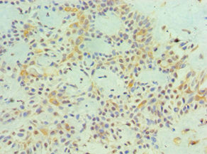 Immunohistochemistry of paraffin-embedded human breast cancer using the antibody at dilution of 1:100