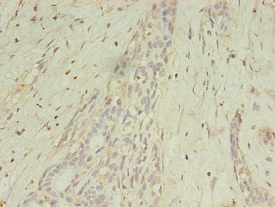 Immunohistochemistry of paraffin-embedded human breast cancer using MAGEA10 Antibody at dilution of 1:100